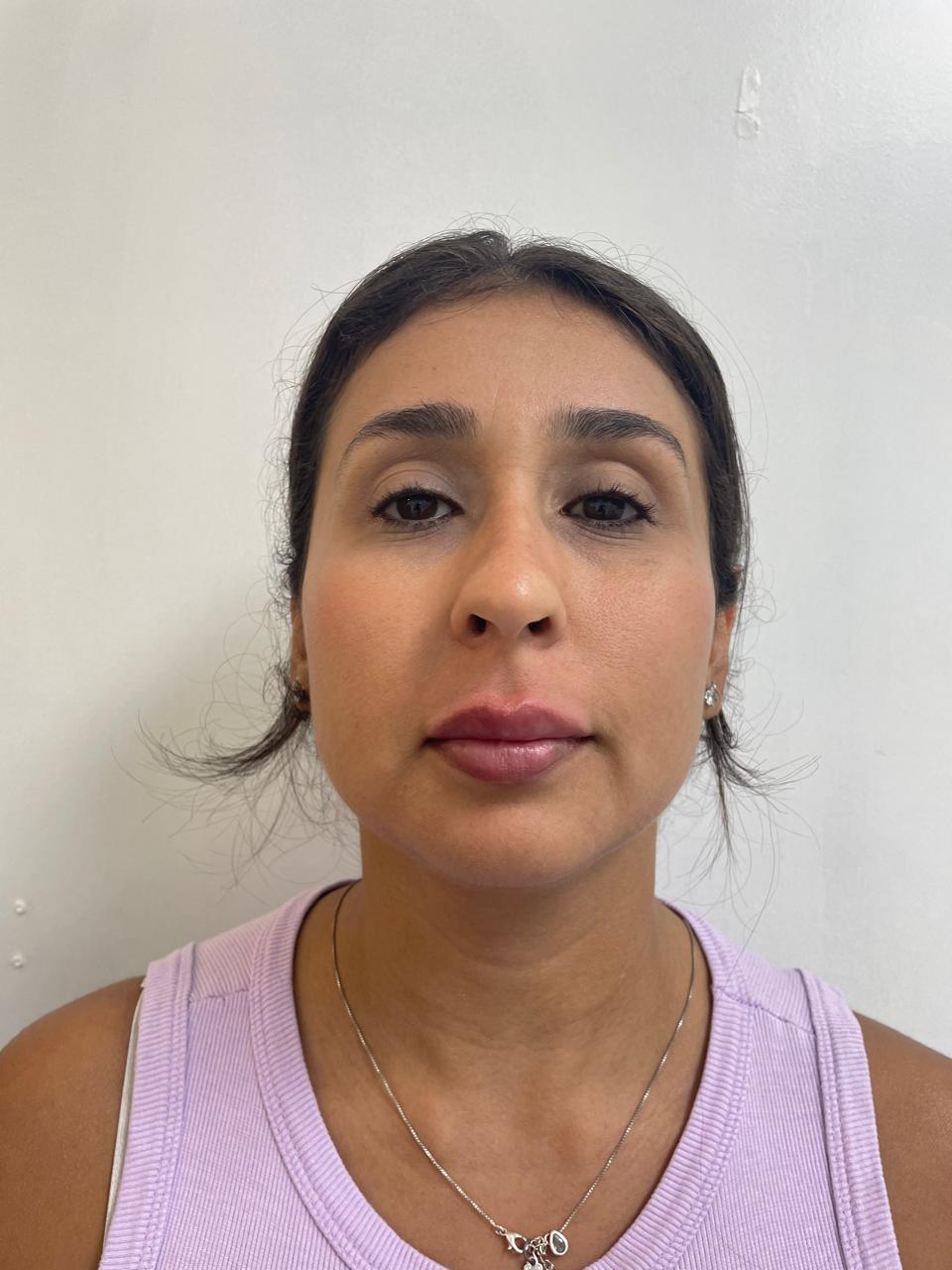 Depois do tratamento